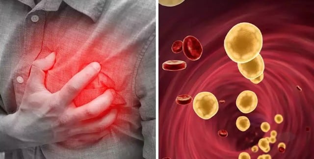 Cholesterol: Symptoms, Types, and Remedies