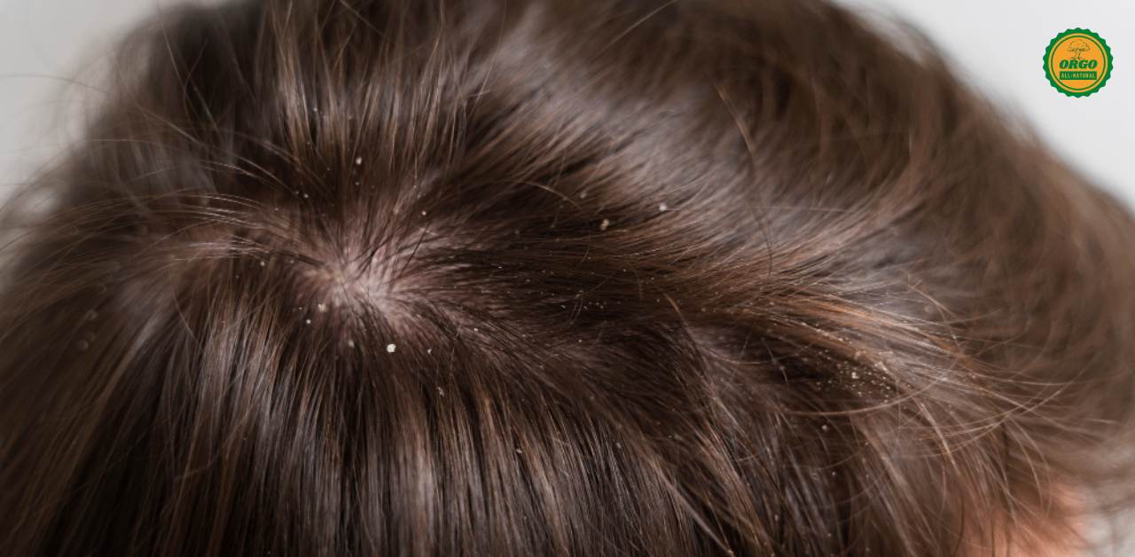 Best Home Remedies for Dandruff