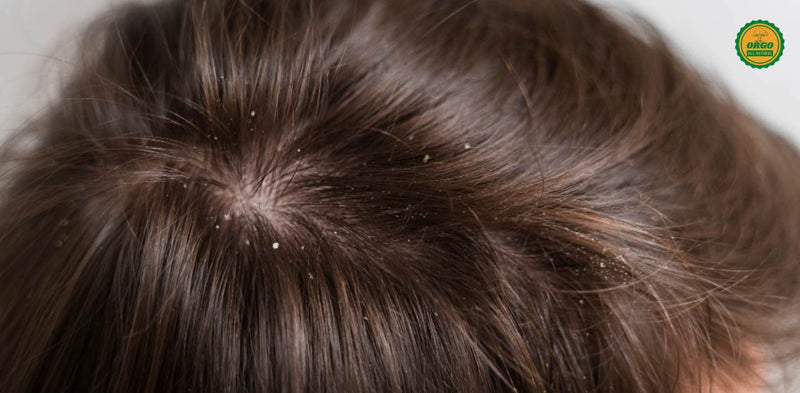 Best Home Remedies for Dandruff